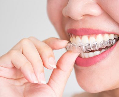 How Much Does Invisalign Cost or Service?