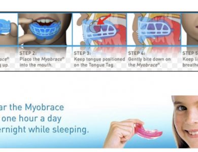 Myobrace