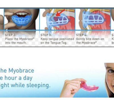 Myobrace