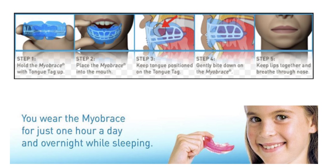 Myobrace Appliance For Jaw Alignment Complete Orthodontics Dental Care Myobrace Appliance For Jaw Alignment Complete Orthodontics Dental Care